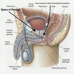 Retzius Sparing Radical prostatectomy